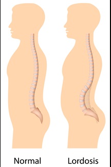 Lordosis And Normal Postural Comparison