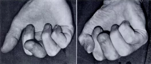 Lumbrical-plus finger