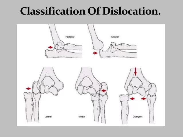 Dislocation of Elbow Classification
