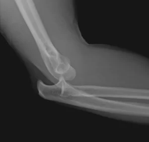 Dislocation of Elbow