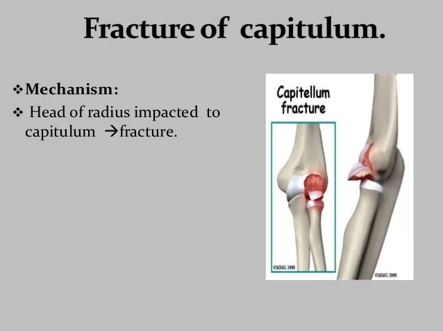 Fracture of the Capitulum