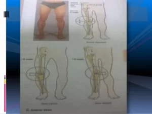 Knee Joint Deformity