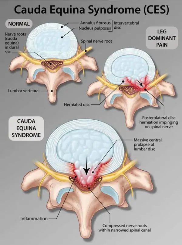 Cauda equina syndrome(CES)