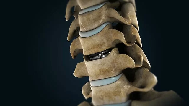 ARTIFICIAL DISC SURGERY