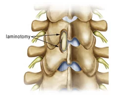 LAMINOTOMY