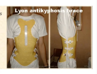 LYON ANTIKYPHOSIS BRACE