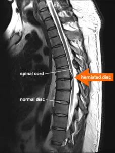 MRI OF SPINE