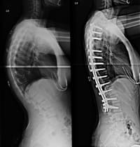 SPINAL FUSION