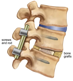 SPINAL FUSION