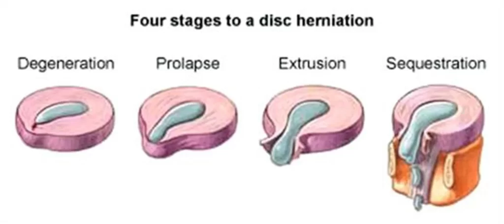 STAGES OF DISC HERNIATION
