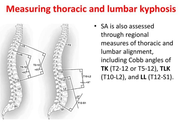 Thoracic kyphosis Measurement