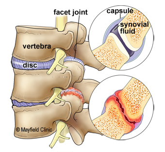 FACET JOINT SYNDROME : Cause, Symptoms, Treatment, Exercise