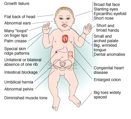 symptoms of Down syndrome