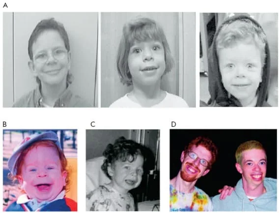 Williams syndrome