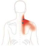 Levator scapulae syndrome : Physiotherapy Treatment - Samarpan ...