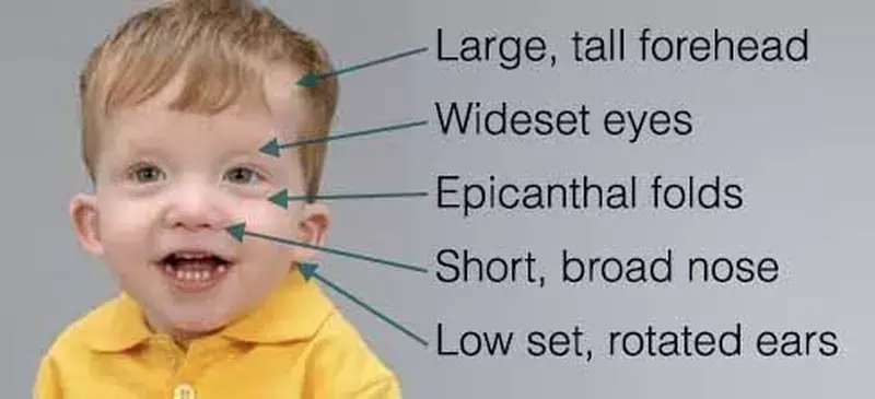 Noonam syndrome
