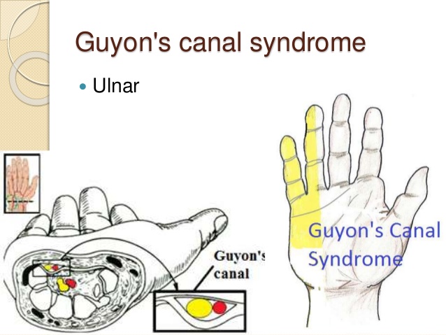 GUYON'S CANAL SYNDROME
