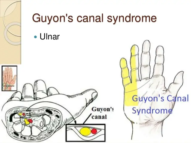 Guyon’s Canal Syndrome