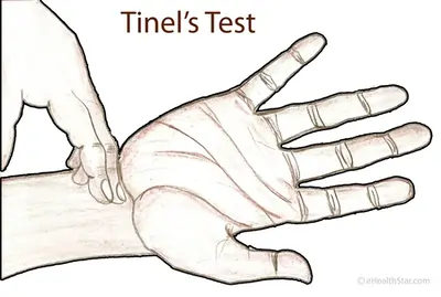 Tinels sign