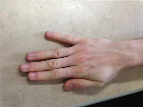 Wartenberg sign