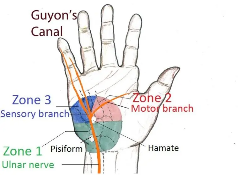 ZONE-OF-GUYONS-CANAL-SYMDROME