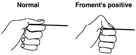 Froment's sign