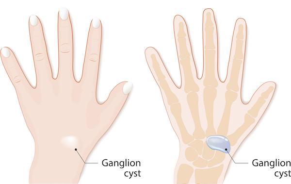 Ganglion cyst 