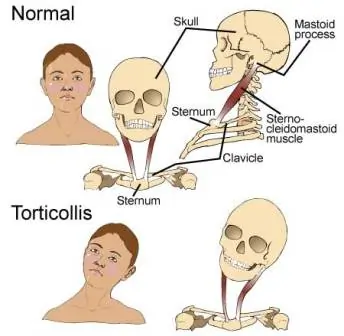 Acquired-torticollis