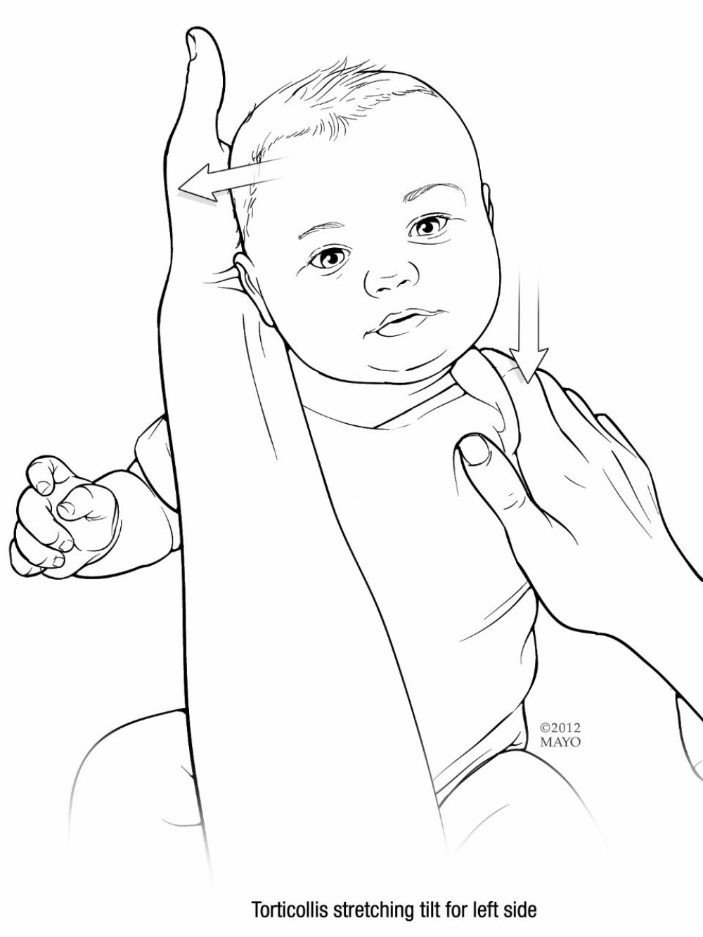 Torticollis: Physiotherapy Treatment