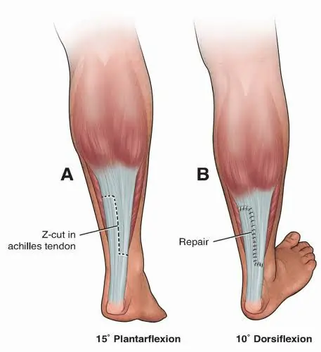 Z plasty For Tendoachilles