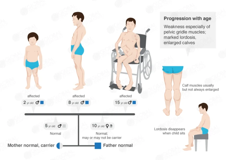 Age-wise Symptoms of DMD
