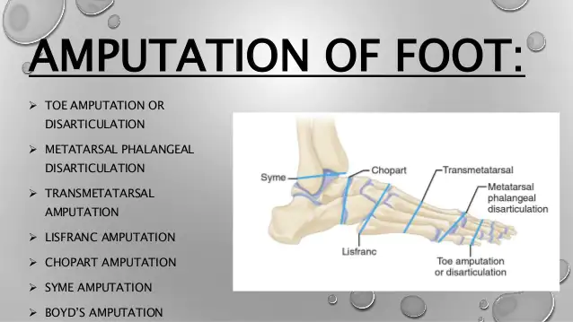 Amputation Of Foot: