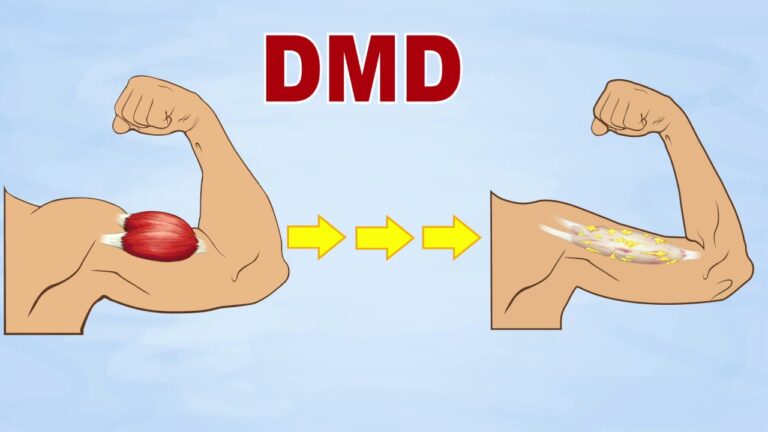 Duchenne muscular dystrophy (DMD) : Cause, Symptoms, Physiotherapy Treatment