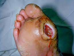 diabetec foot ulcer