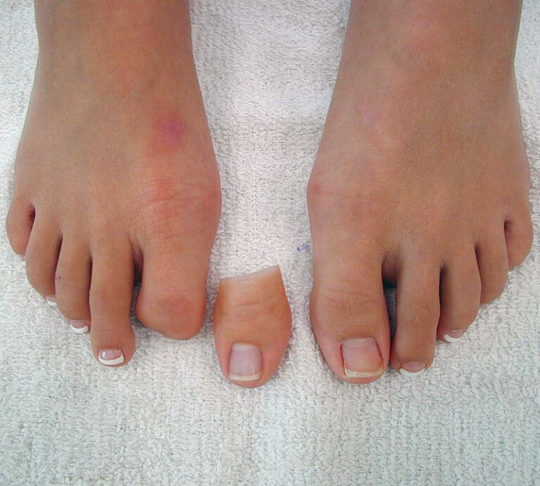 Toe Prosthesis