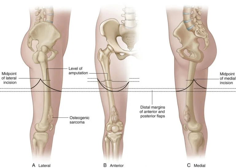 Above Knee Amputation