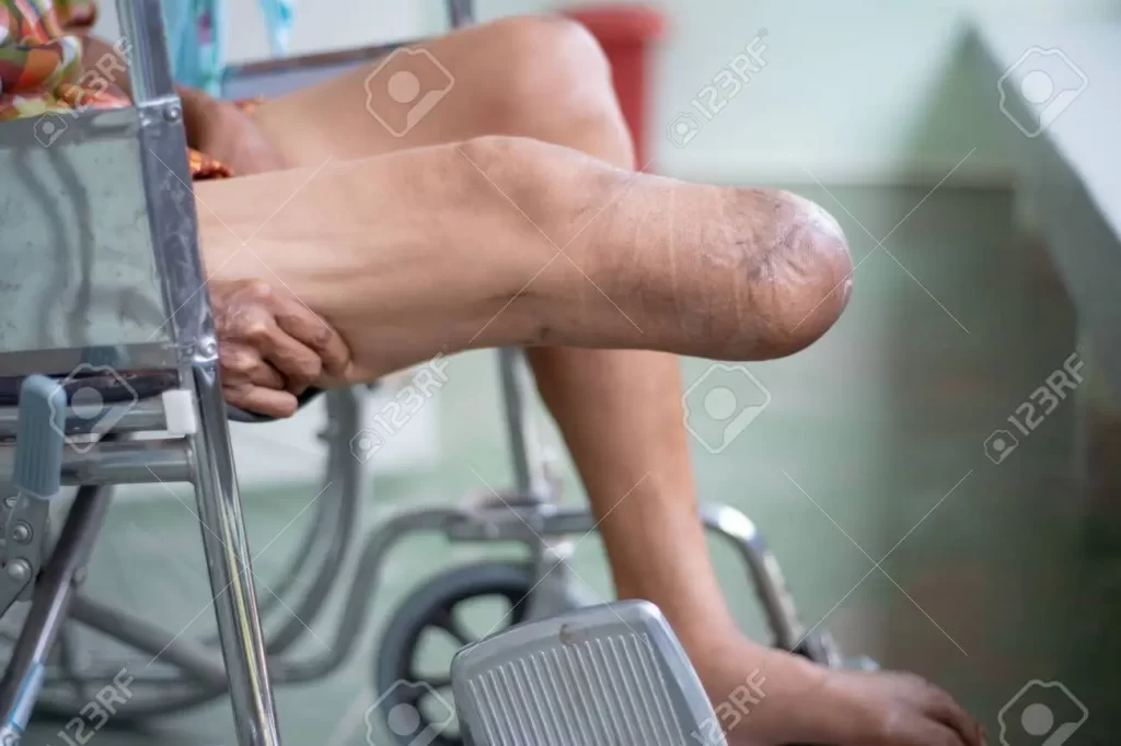 Below Knee Amputation