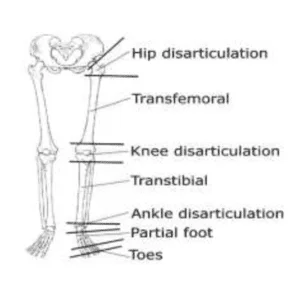 Level Of Lower Limb Amputation