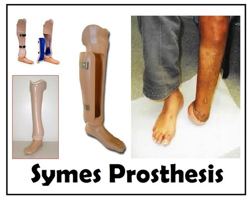 Symps Amputation And Prosthesis