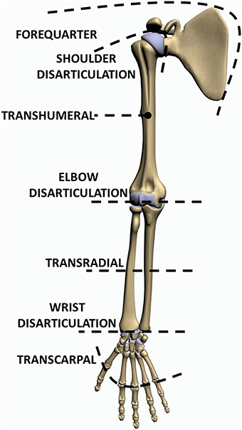 Level of upper limb amputation