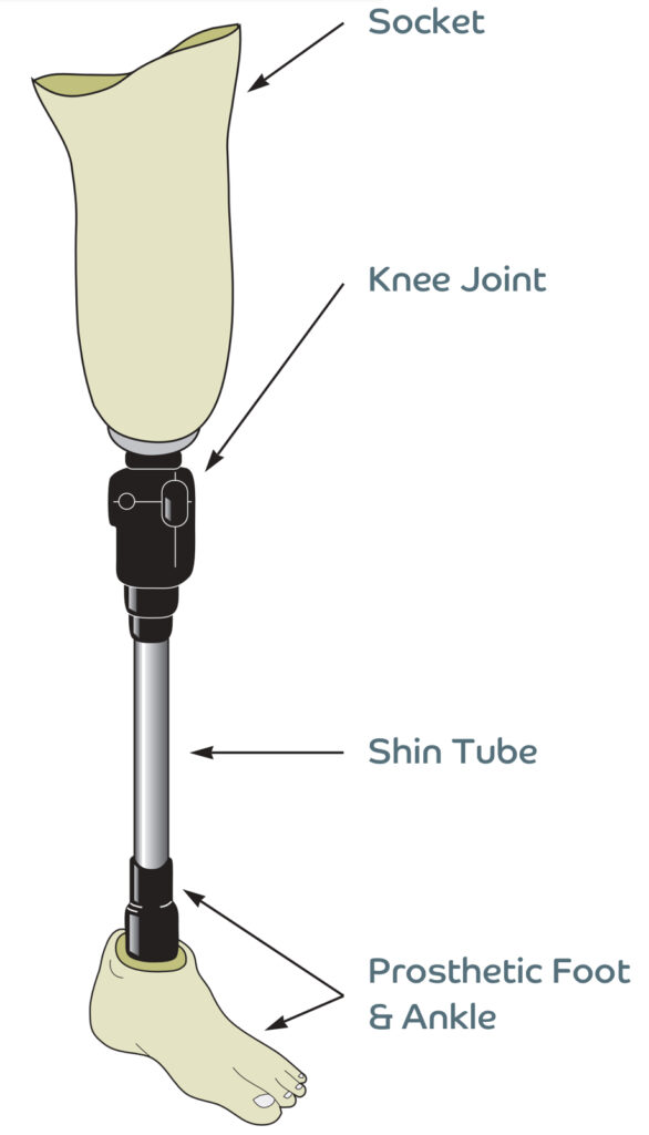 Above Knee Prosthesis