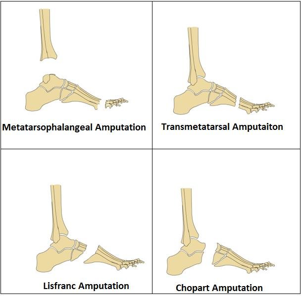1)Metatarsophalangeal Amputation2)Transmetatarsal Amputation 3)Lisfranc Amputation 4)Chopart Amputation