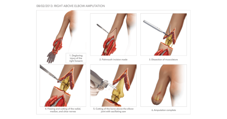 Above Elbow Amputation: Indication, Multydisciplinary team, Surgery, Responsibilities of the team, Physiotherapy treatment, Prosthesis, Complications
