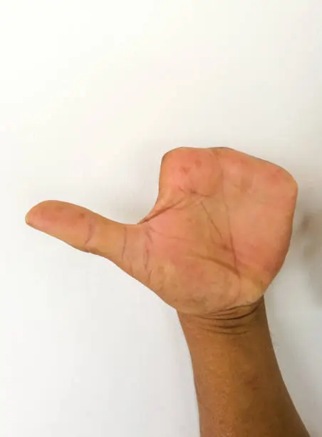 Amputation through the proximal phalanx of a finger