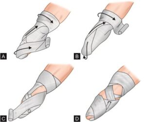 Below elbow amputation: Indication, Prosthesis, Treatment