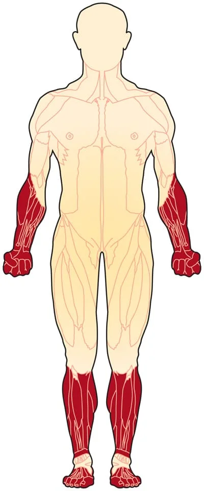 Distal Muscular Dystrophy: Cause, Type, Symptoms, Treatment