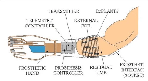 Myoelectric Prosthesis