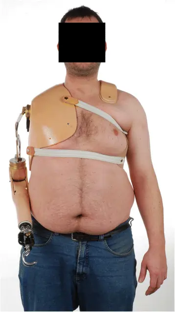 Prosthesis for Forequarter Amputation