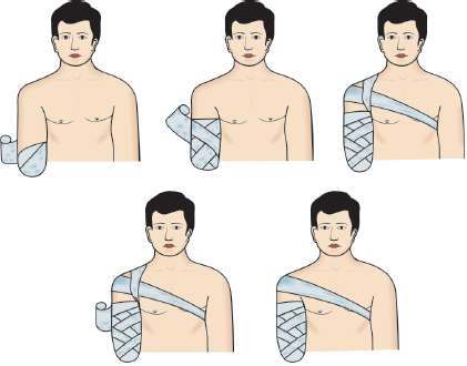 Stump Bandages For Above Elbow Amputation