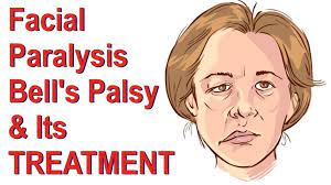 Bell’s Palsy: Cause, Symptoms, Diagnosis, Treatment, Exercise
